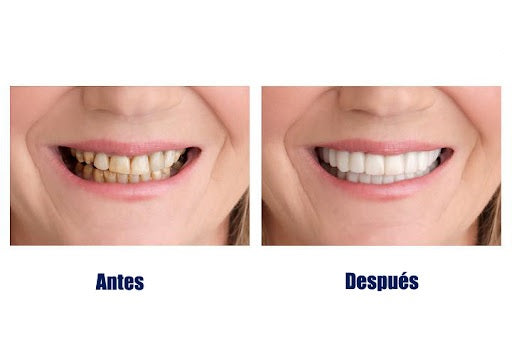 Carillas Estéticas Removibles - Snap on Smile