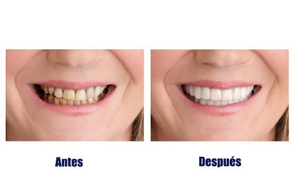 Carillas Estéticas Removibles - Snap on Smile